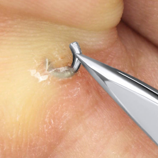 Splinter Remover